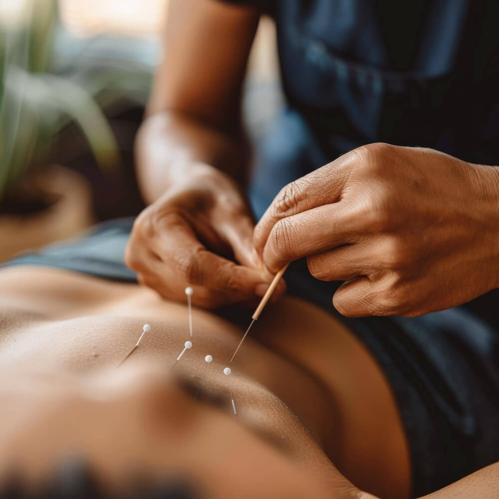 A close-up of a practitioner performing acupuncture on a patient's abdomen.